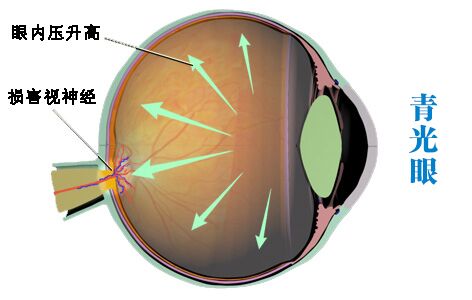 青光眼的早期癥狀